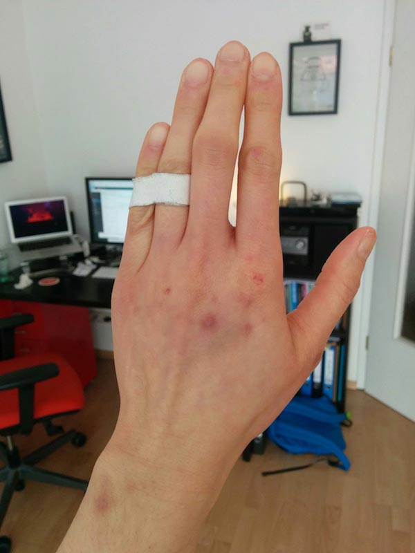 Buddy taping pinky finger to limit movement